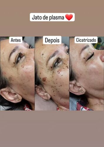 Antes e depois